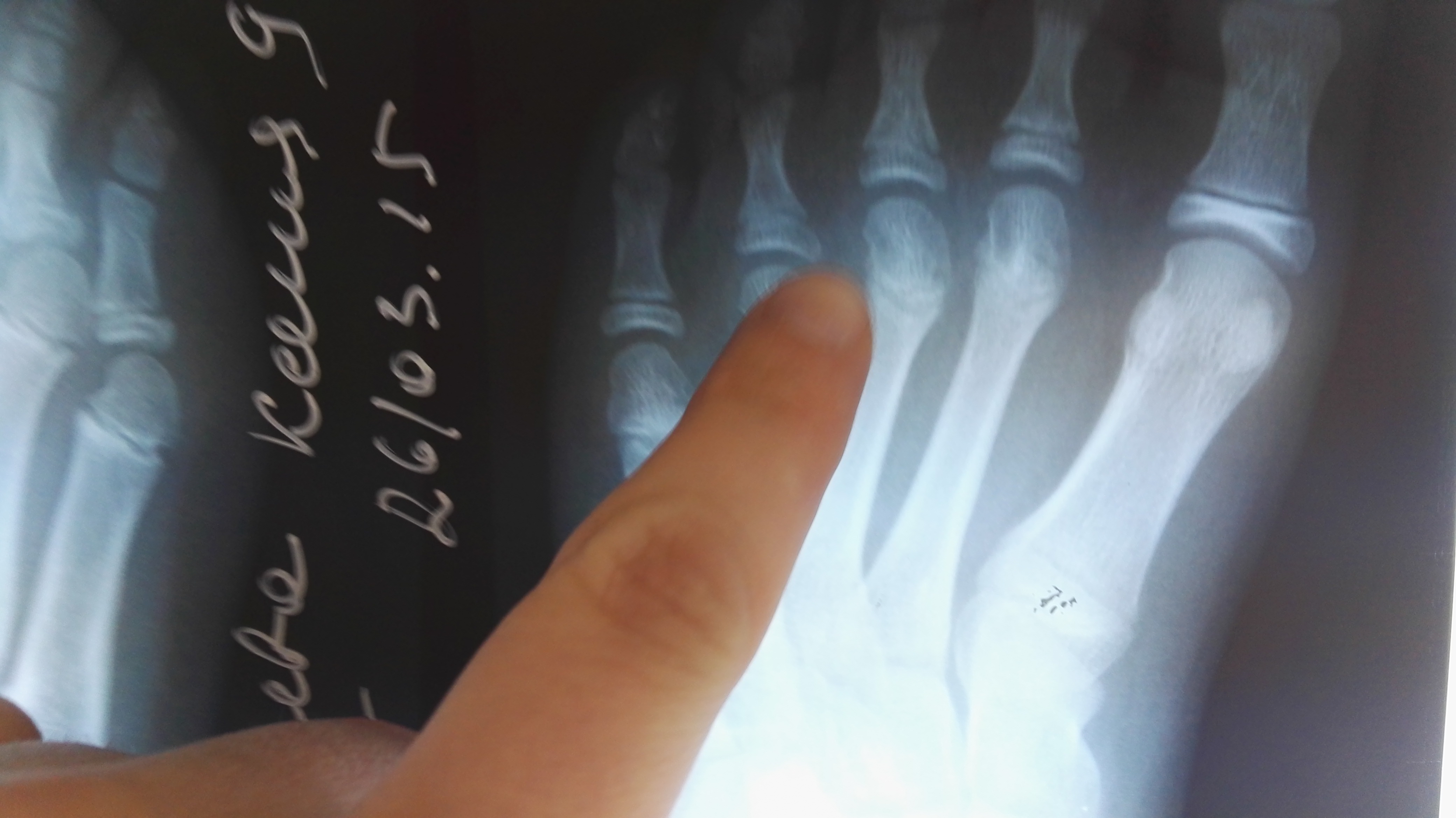 Перелом безымянного пальца стопы рентген