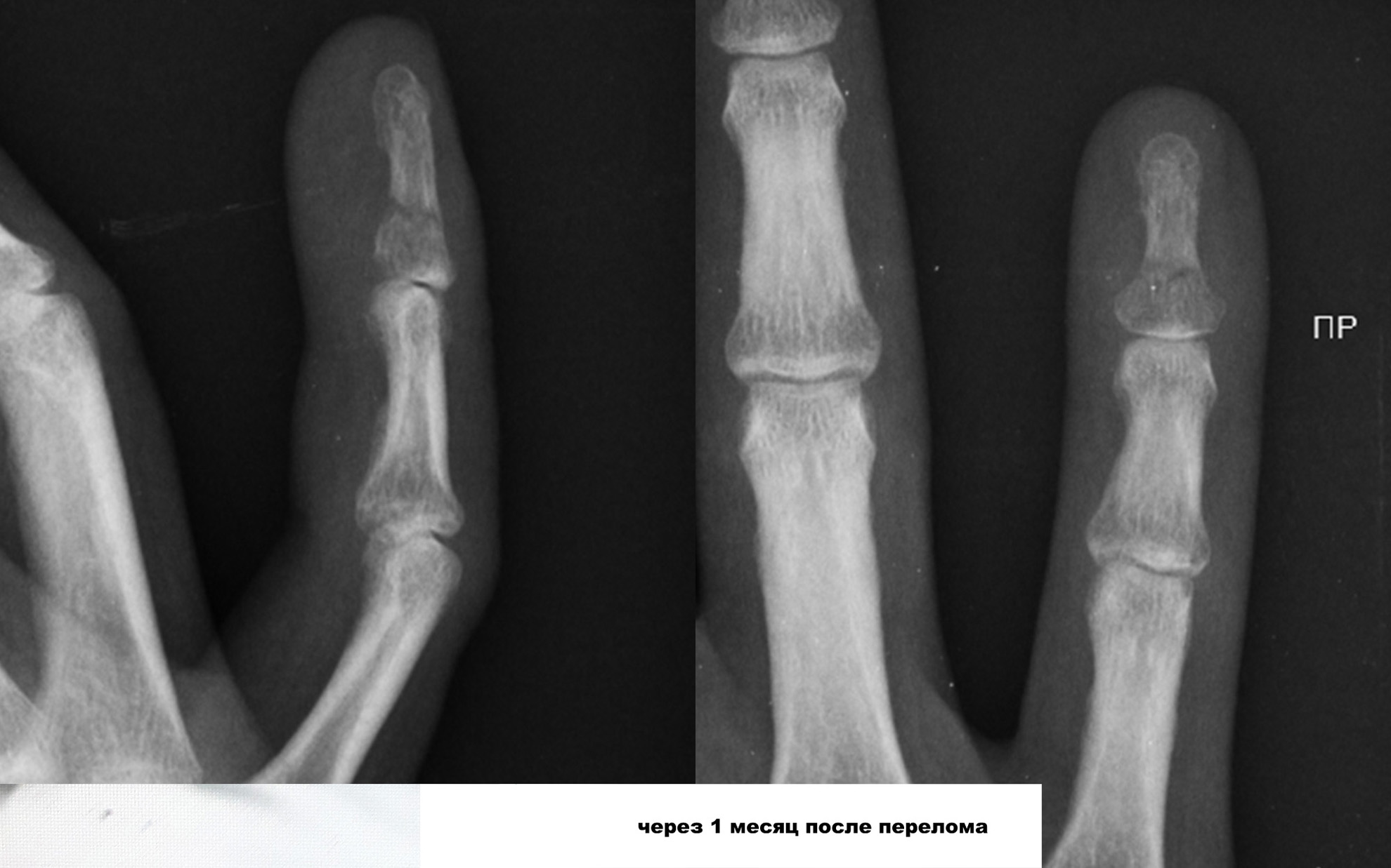 Открытый перелом фаланги. Посттравматический артрит рентген. Артрит голеностопа мкб 10. Травматический артрит коленного сустава мкб 10. Посттравматический артроз.