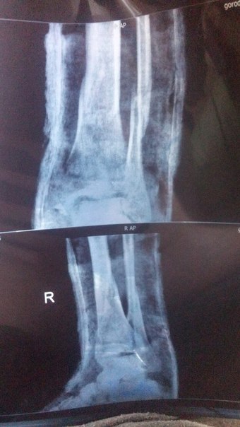 6 недель перелом. Перелом малой берцовой кости у кошки. Снимок перелома берцовой после 6 недель. Снимок перелома берцовой спустя 8 недель. Перелом снимок и в реальности.